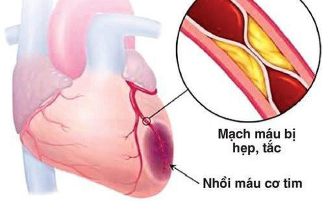 Thiếu máu cơ tim cục bộ - Hình ảnh minh họa